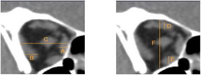 Selective deficits of S-cone in thyroid-associated ophthalmopathy patients without clinical signs of dysthyroid optic neuropathy